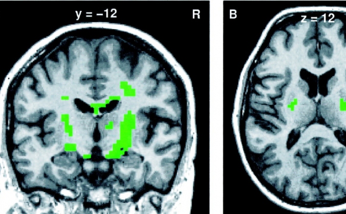 Research Elective in Motor Neurone Disease/ALS