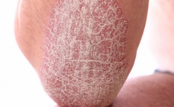 Psoriasis Improvement