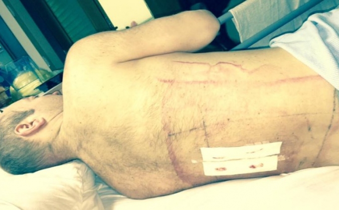 Cyclist knocked down by motorist - broken back