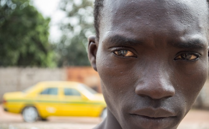 Life-Changing eye surgery for Bakary