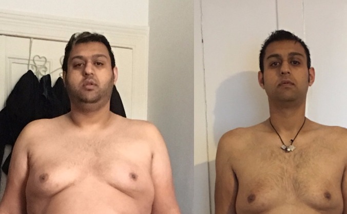 Skin Removel Surgery