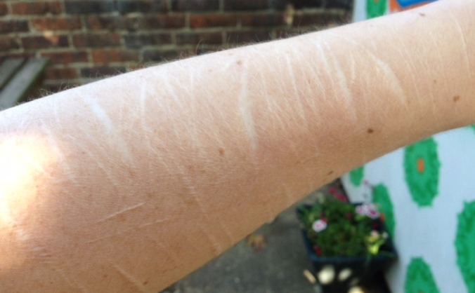 Help Me Shed My Scarred Skin