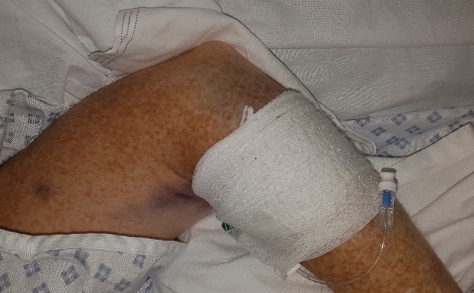 Jillian stroke recovery