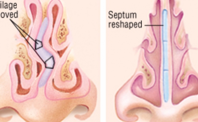 Please help me get my nose fixed
