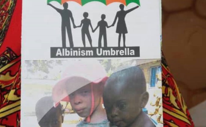 Albinism Umbrella
