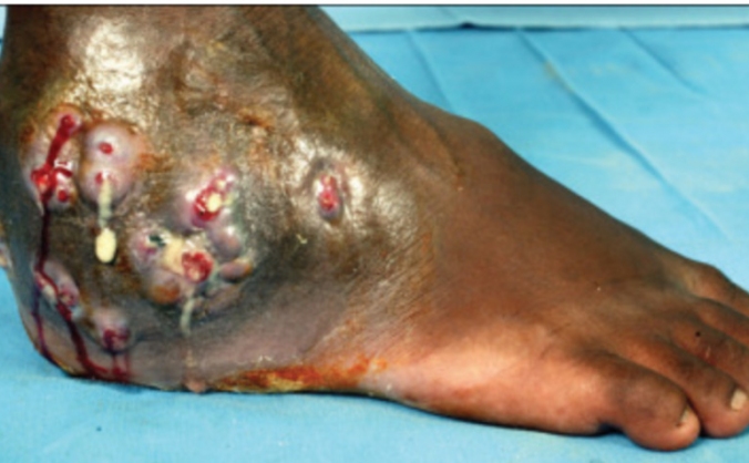 Supporting the treatment of patients with mycetoma