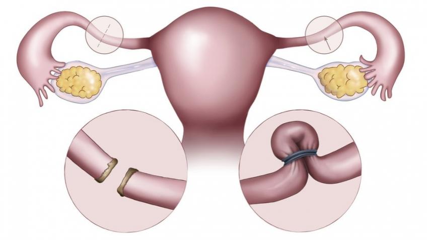 sterilization reversal