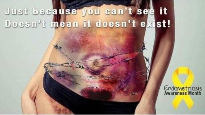 Endometriosis surgery so I can get back to work