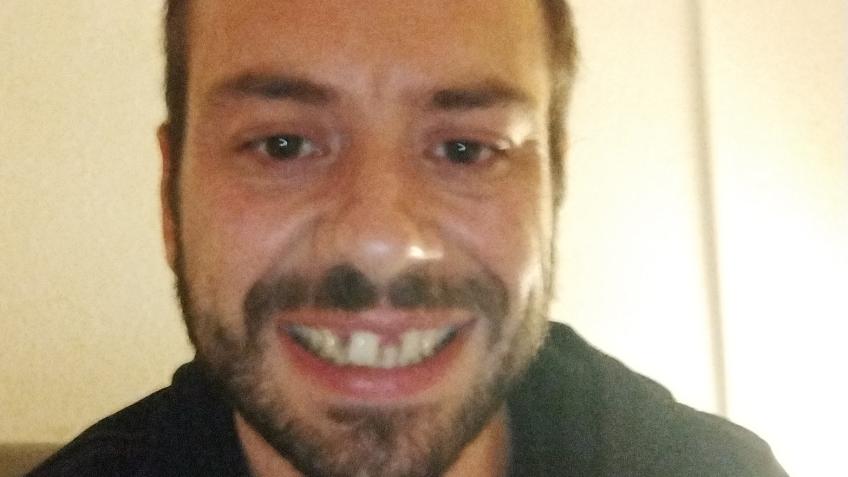 Help with dental costs for front teeth