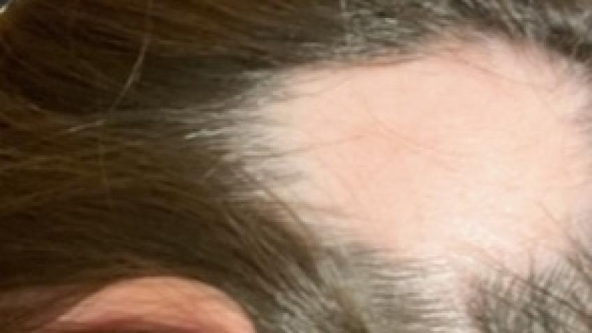 Treatment for Alopecia Areata