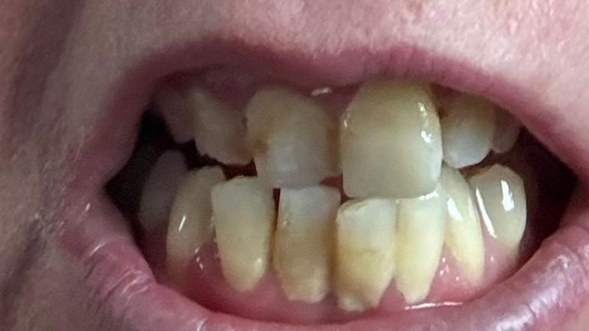 Teeth straightening