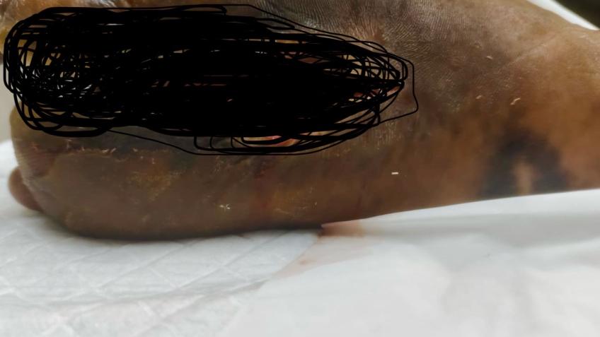 Saving My Dad’s Foot and Life – We Need Your Help