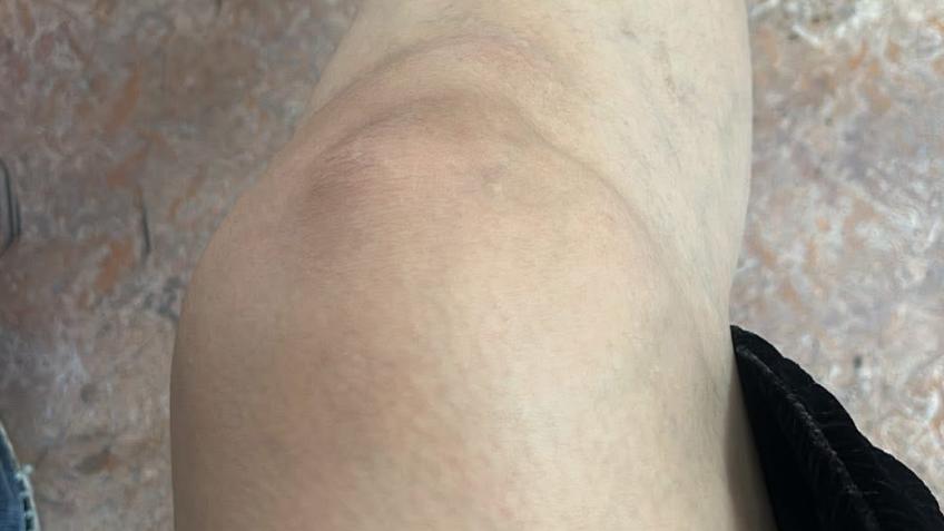 Help me to fix my knee