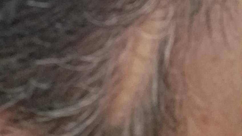 Hair implant surgery