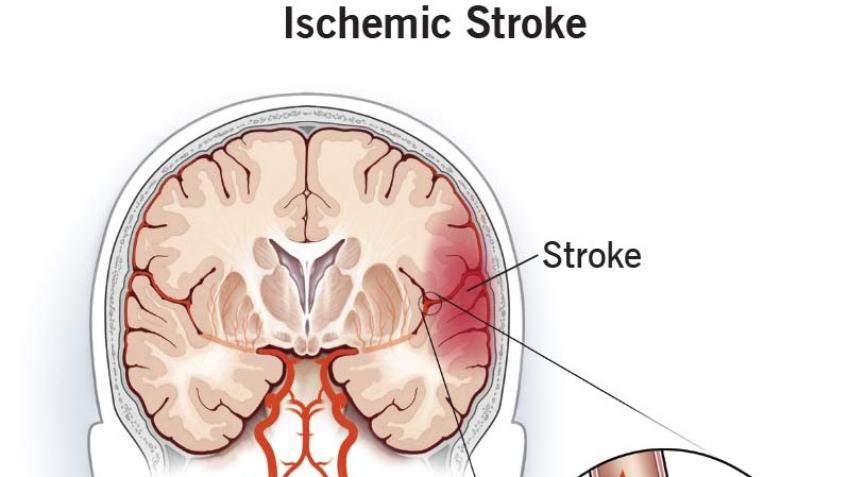 A Stroke Survivor in Need of Financial Support