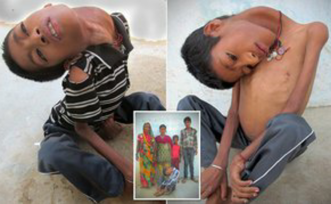 Mahendra Ahirwar 'cursed' with no neck muscles