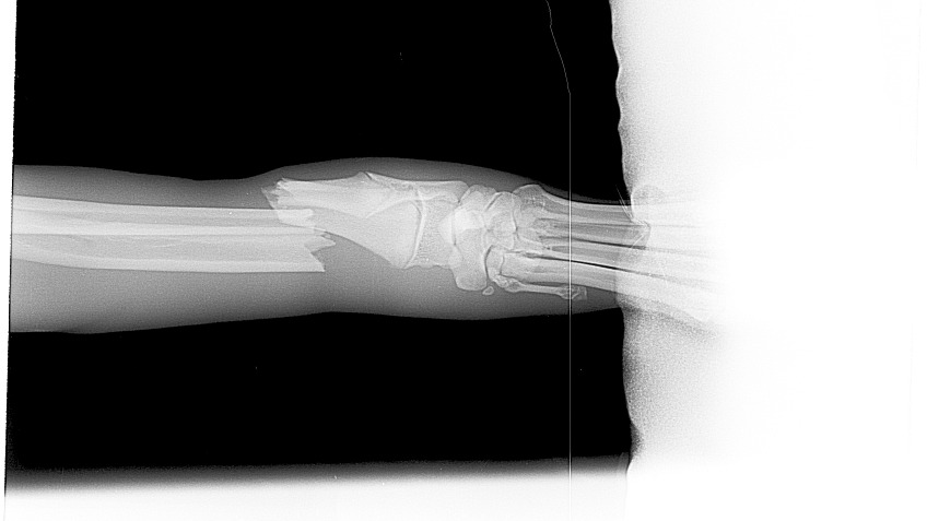 Jake's leg repair  