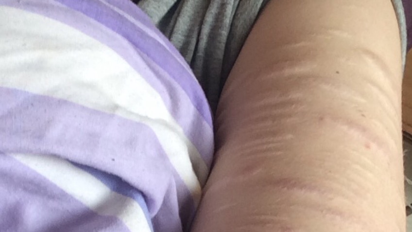 Help me cover my self harm scars - a Social Enterprise crowdfunding project  in Manchester by Theforceawakens