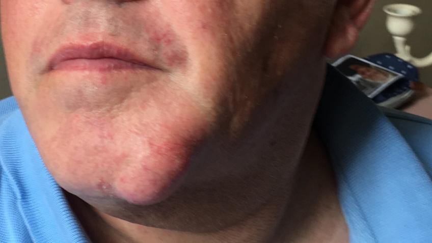 Remove My Lump And Set Me Free A Personal Causes Crowdfunding Project In Bridlington By David Burnham bridlington by david burnham