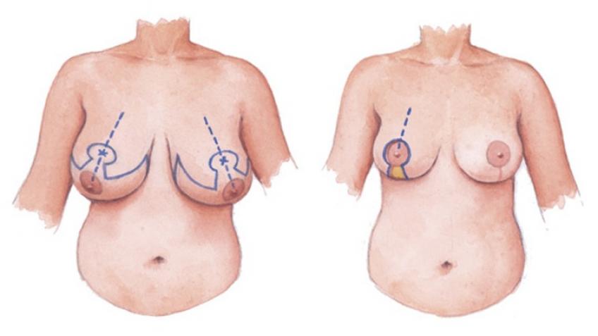 Help me get breast surgery!!